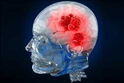 Global Brain Tumor Diagnosis And Treatment Market Company Profile and its Business Tactics & Demand Forecast 2022-2028