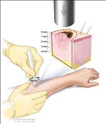 Global Cancer Biopsy Market